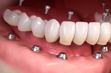 Waarom Steeds Meer Mensen Kiezen Voor All-on-vier Implantaten in Albanië
