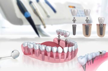 Pourquoi Choisir All-on-4 Albanie pour une Nouvelle Vie Souriante